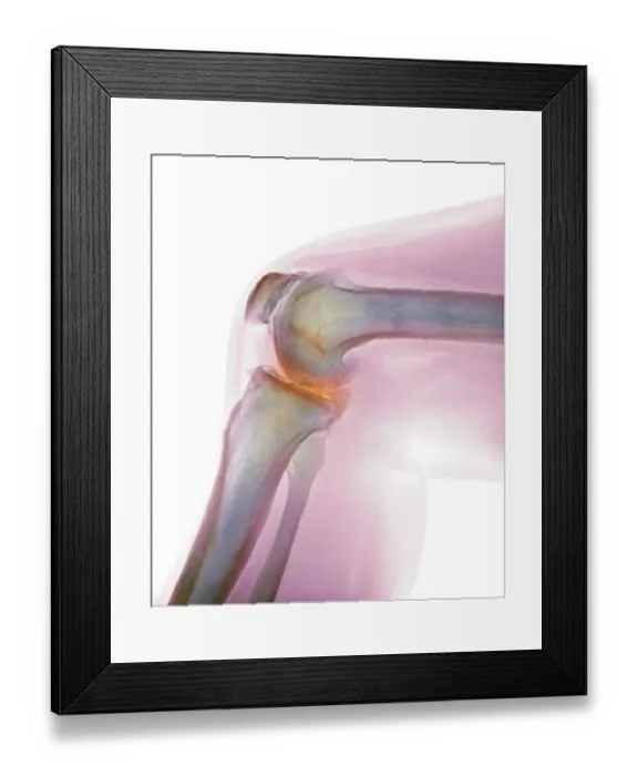 Framed Print : Arthritis of the knee, X-ray Framed Print : Arthritis of the knee, X-ray