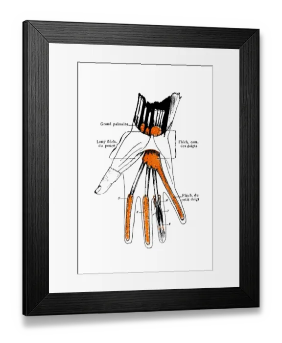 Framed Print : Synovial sheaths of wrist, palm and fingers Framed Print : Synovial sheaths of wrist, palm and fingers