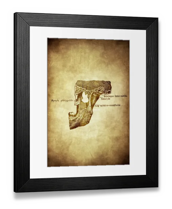 Framed Print : Ossification of the tibia and fibula (leg bone) Framed Print : Ossification of the tibia and fibula (leg bone)