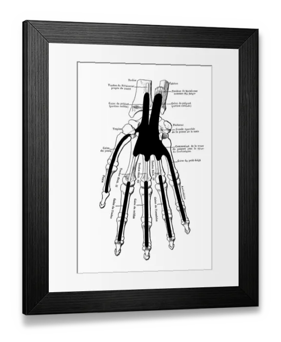 Framed Print : The skeleton of the hand with muscle insertions and tetives, ligaments