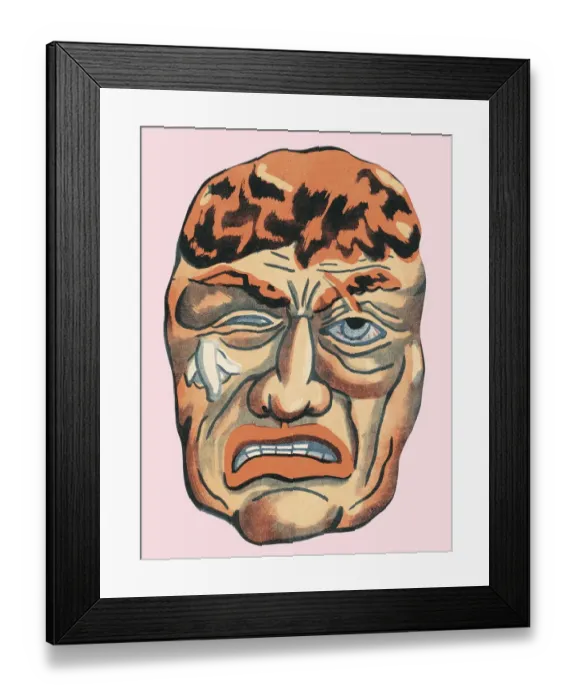 Framed Print : Man with exposed brain Framed Print : Man with exposed brain
