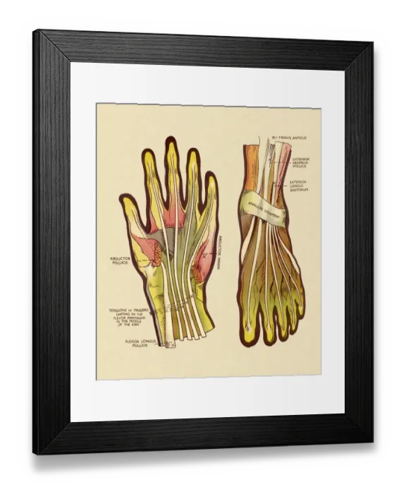 Framed Print : Tendons and Ligaments in Hand and Foot Framed Print : Tendons and Ligaments in Hand and Foot