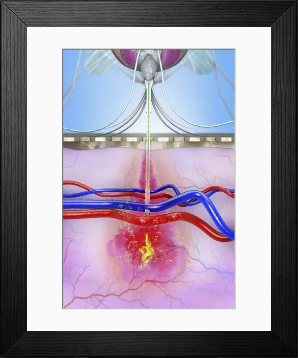 Framed Print : Malaria transmission, illustration Framed Print : Malaria transmission, illustration