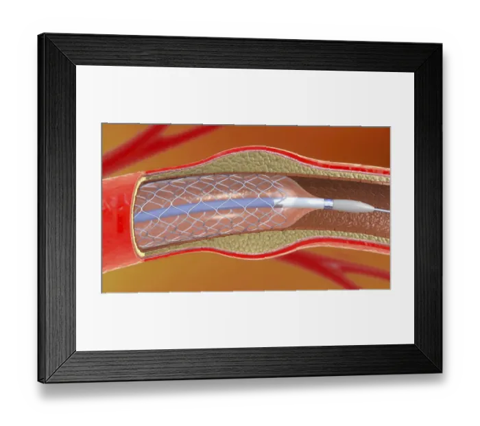 Framed Print : Arterial stent, illustration Framed Print : Arterial stent, illustration