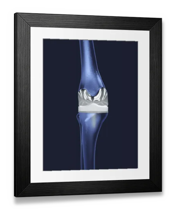 Framed Print : Knee replacement, illustration Framed Print : Knee replacement, illustration