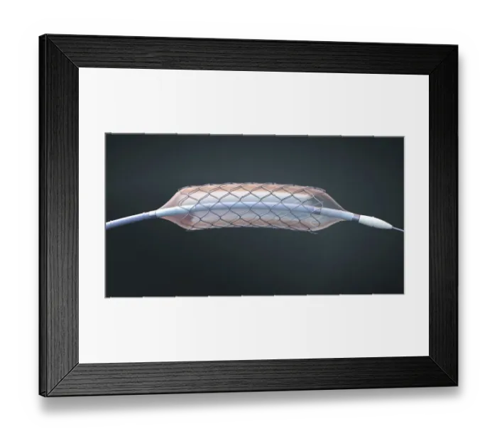 Framed Print : Stent and balloon catheter, illustration Framed Print : Stent and balloon catheter, illustration
