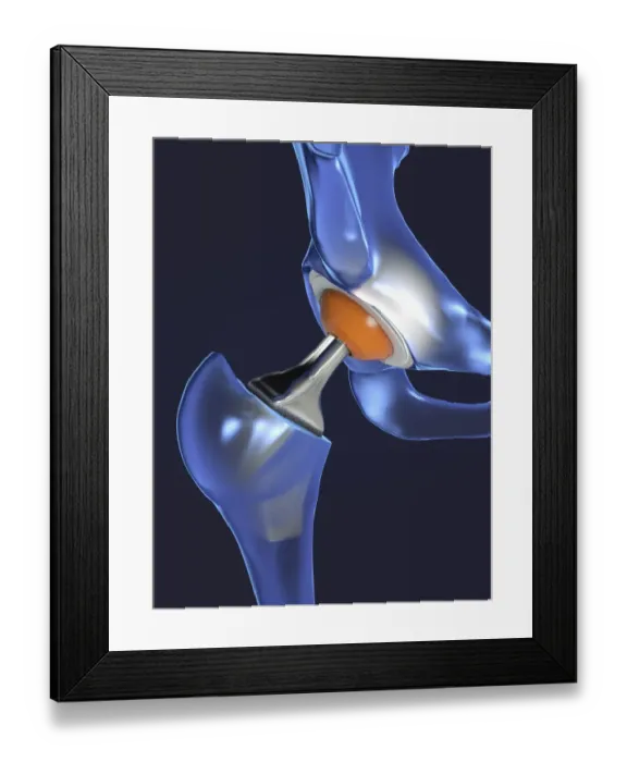 Framed Print : Hip replacement, illustration Framed Print : Hip replacement, illustration