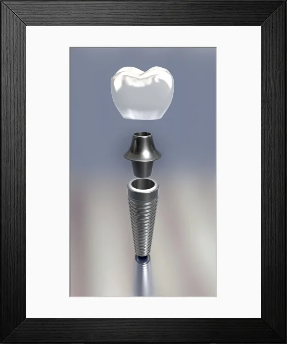 Framed Print : Dental implant, illustration Framed Print : Dental implant, illustration