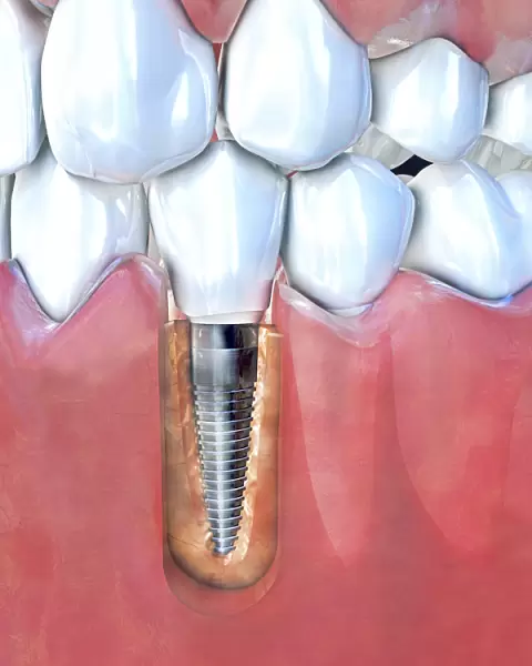 Dental implant, illustration