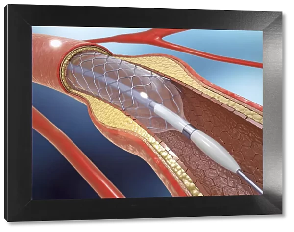 Arterial stent, illustration