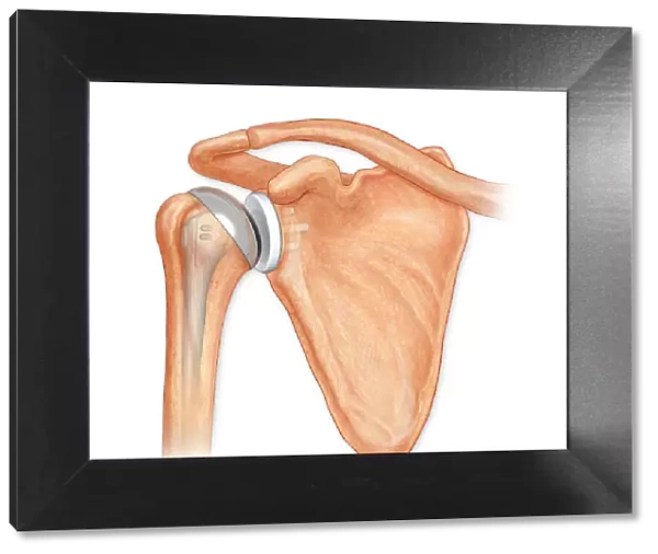 Anterior view total shoulder joint repair