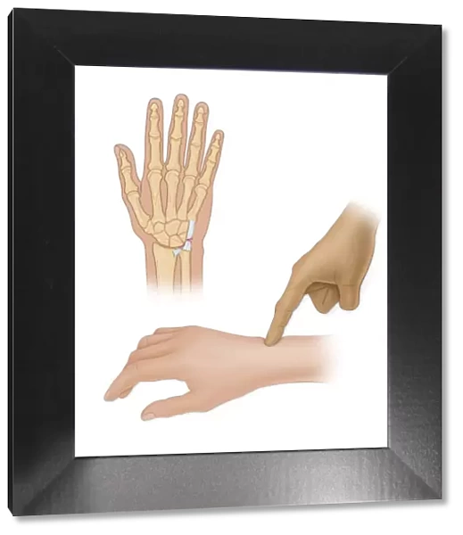 Hand bones with injury and finger pointing to wrist