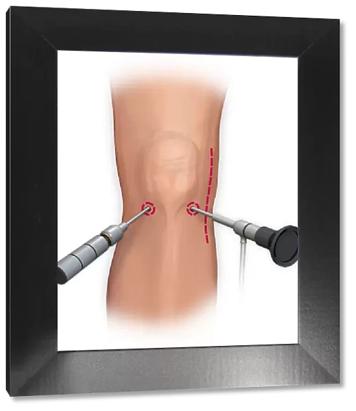 Arthroscopic surgical repair of the knee