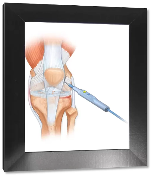 Bovie used to cut through retincaculum, and clean up femur of Displaced patellar knee
