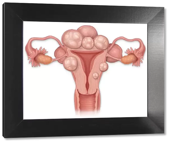 Female anterior cross sectional view of a uterus with fibroids, vagina, cervix