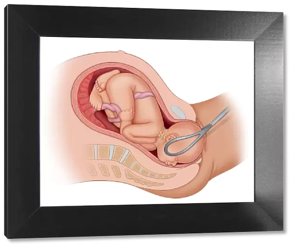 Cross section of the mothers anatomy showing the baby in uteruo LOA being delivered