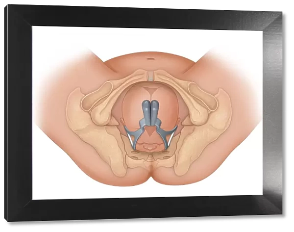 Doctors view of a baby in occiptital anterior position being delivered by proper use of
