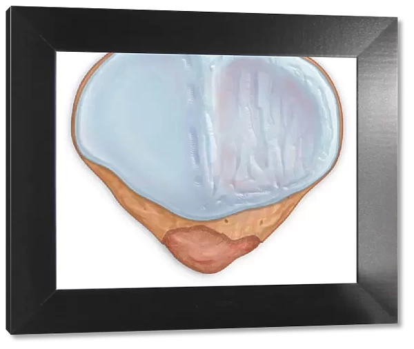Posterior view patellar surface showing and injured cartilage surface