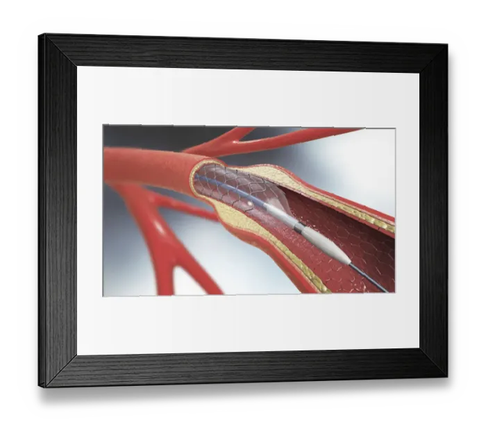 Framed Print : Arterial stent, illustration Framed Print : Arterial stent, illustration