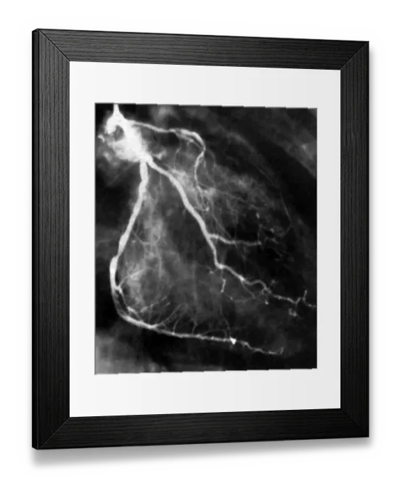 Framed Print : Narrowed coronary arteries (B&W) Framed Print : Narrowed coronary arteries (B&W)