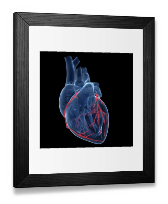 Framed Print : Coronary arteries, artwork Framed Print : Coronary arteries, artwork