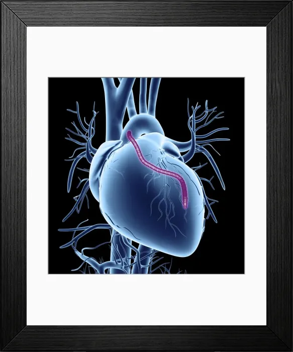 Framed Print : Heart bypass graft, artwork Framed Print : Heart bypass graft, artwork
