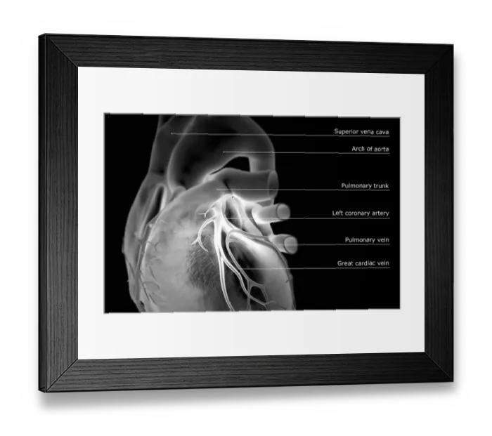 Framed Print : The coronary vessels of the heart Framed Print : The coronary vessels of the heart