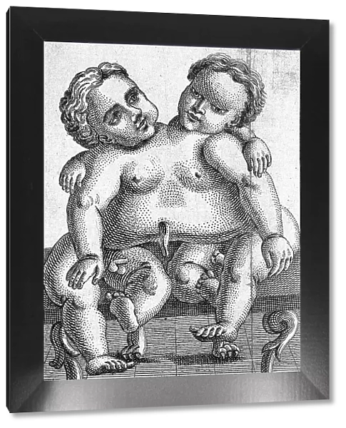 Siamese twins born in Palermo in 1755, Sicily, Italy, Historical, digitally restored reproduction from a 19th century original