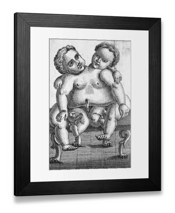 Framed Print : Siamese twins born in Palermo in 1755, Sicily, Italy, Historical, digitally restored reproduction from a 19th century original Framed Print : Siamese twins born in Palermo in 1755, Sicily, Italy, Historical, digitally restored reproduction from a 19th century original