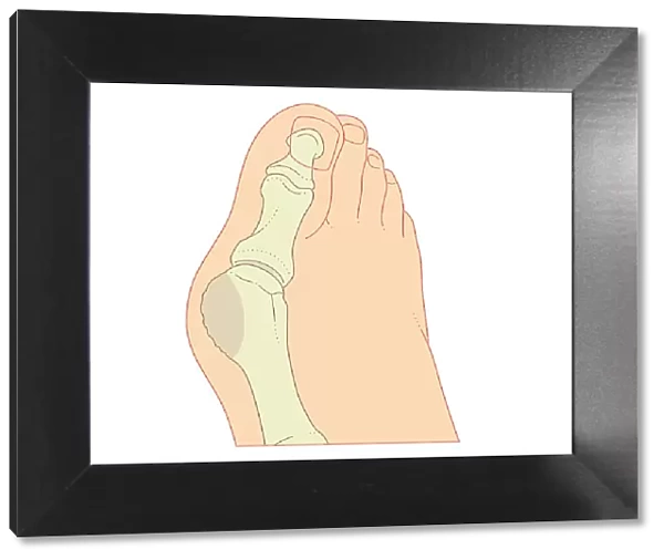 Digital illustration of bunion with enlargement of bone around joint at base of big toe