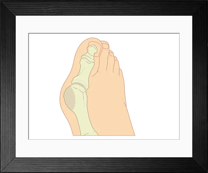 Framed Print : Digital illustration of bunion with enlargement of bone around joint at base of big toe