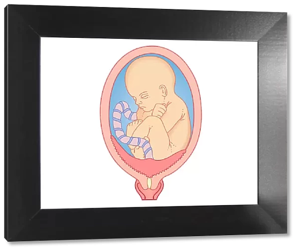 Digital illustration showing placenta praevia where the placenta is attached to the uterine wall, entirely covering the cervix