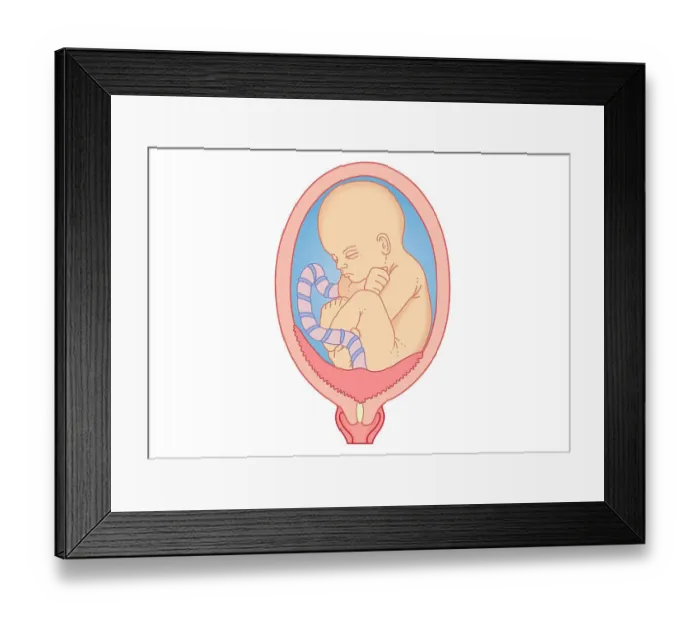 Framed Print : Digital illustration showing placenta praevia where the placenta is attached to the uterine wall, entirely covering the cervix Framed Print : Digital illustration showing placenta praevia where the placenta is attached to the uterine wall, entirely covering the cervix