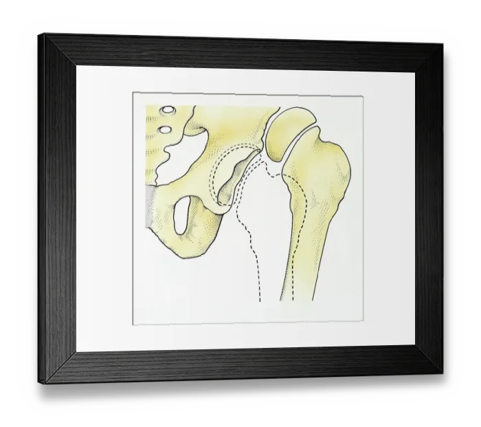 Framed Print : Digital illustration of dislocated hip Framed Print : Digital illustration of dislocated hip