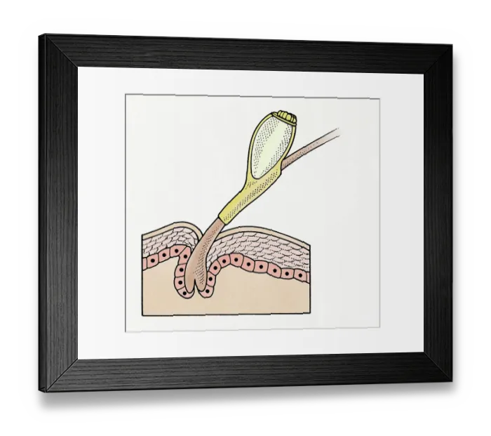 Framed Print : Cross section illustration of Head Louse (Pediculus humanus capitis) egg on human hair Framed Print : Cross section illustration of Head Louse (Pediculus humanus capitis) egg on human hair