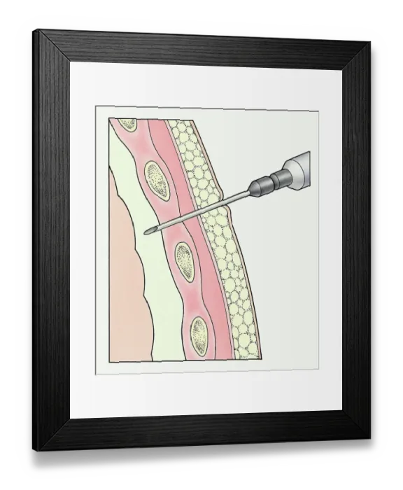 Framed Print : Syringe entering pleural membranes around human lung to extract sample Framed Print : Syringe entering pleural membranes around human lung to extract sample