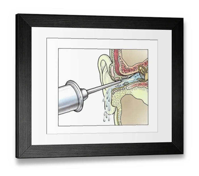 Framed Print : Injecting water into ear with syringe Framed Print : Injecting water into ear with syringe