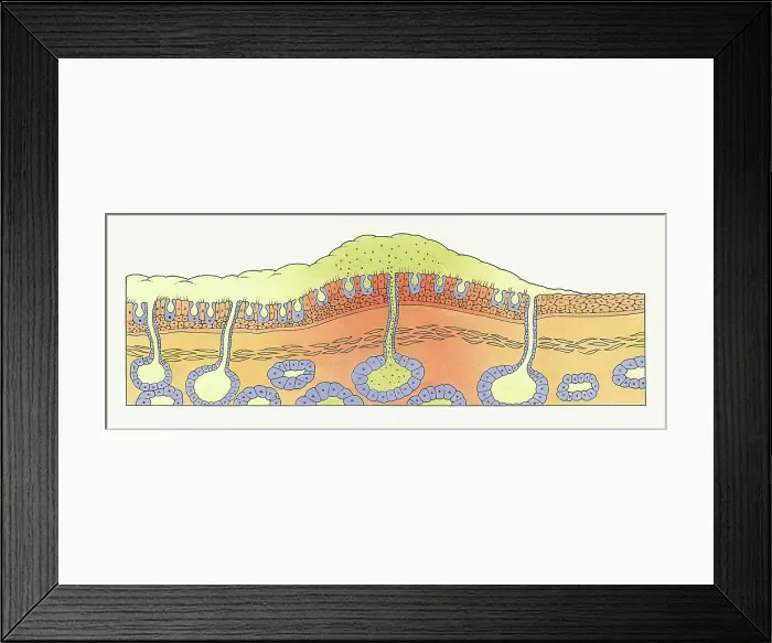 Framed Print : A damaged bronchus Framed Print : A damaged bronchus