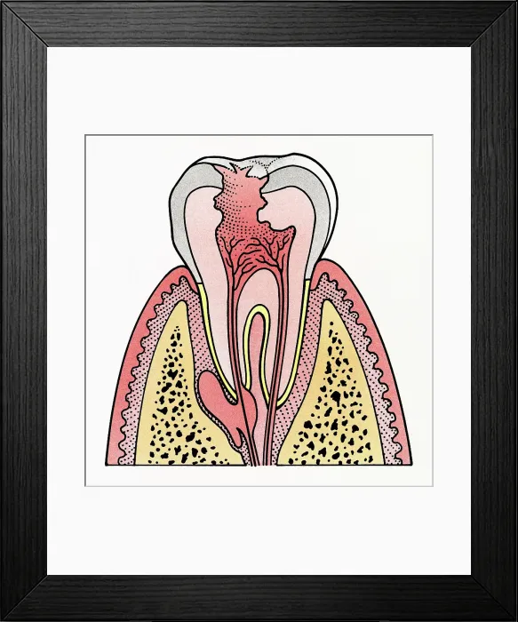 Framed Print : Cross section illustration showing tooth decay Framed Print : Cross section illustration showing tooth decay