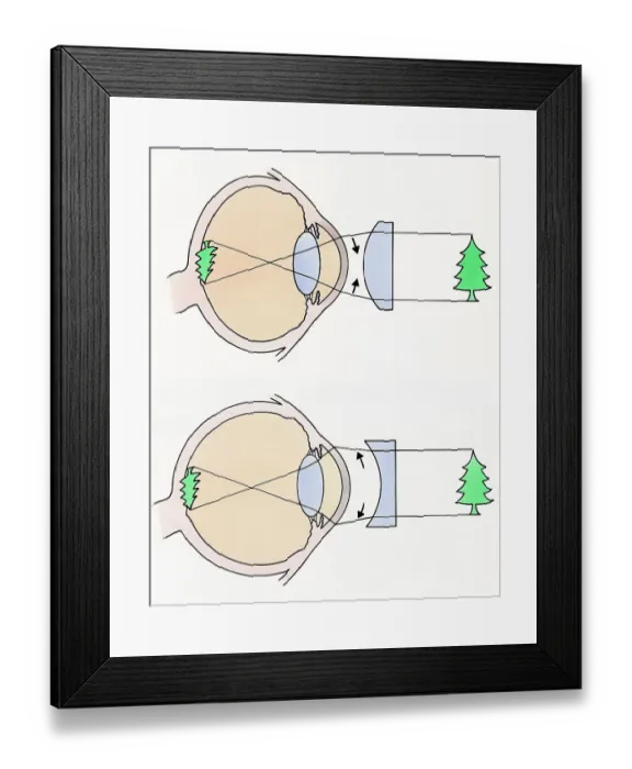 Framed Print : Cross section illustrations of human eyes with concave and concave lenses looking at green tree Framed Print : Cross section illustrations of human eyes with concave and concave lenses looking at green tree