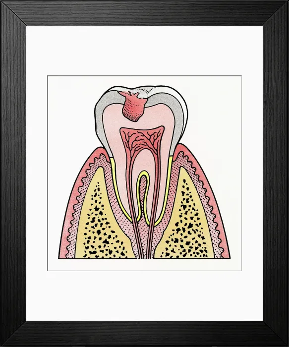 Framed Print : Cross section illustration showing tooth decay Framed Print : Cross section illustration showing tooth decay