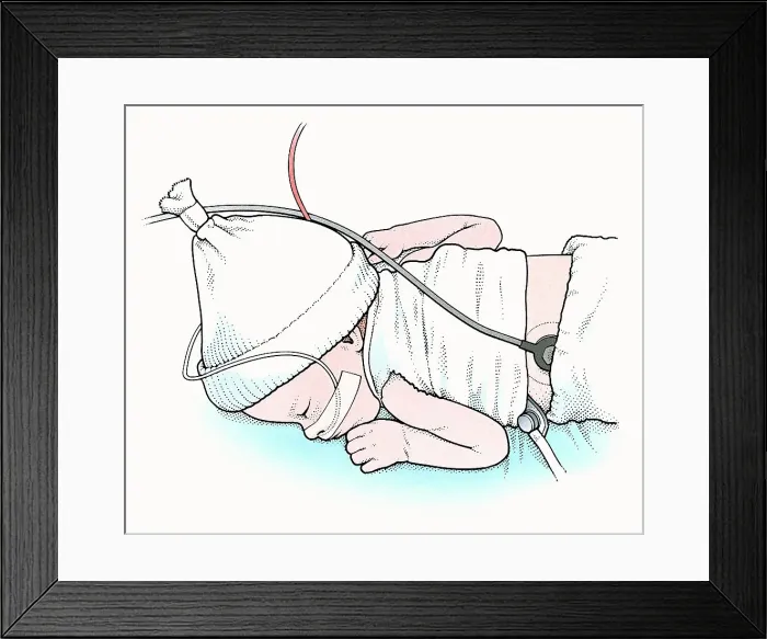 Framed Print : Illustration of baby lying on front in incubator Framed Print : Illustration of baby lying on front in incubator