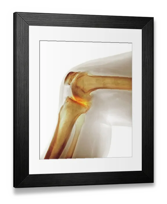Framed Print : Arthritis of the knee, X-ray Framed Print : Arthritis of the knee, X-ray