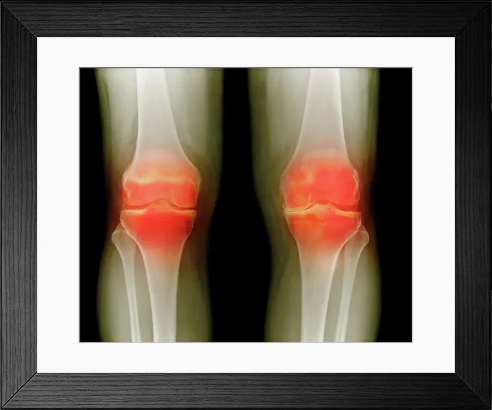 Framed Print : Arthritic knees, X-ray Framed Print : Arthritic knees, X-ray