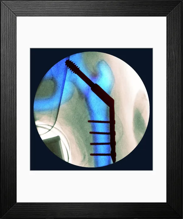 Framed Print : Pinned fractured hip, X-ray Framed Print : Pinned fractured hip, X-ray