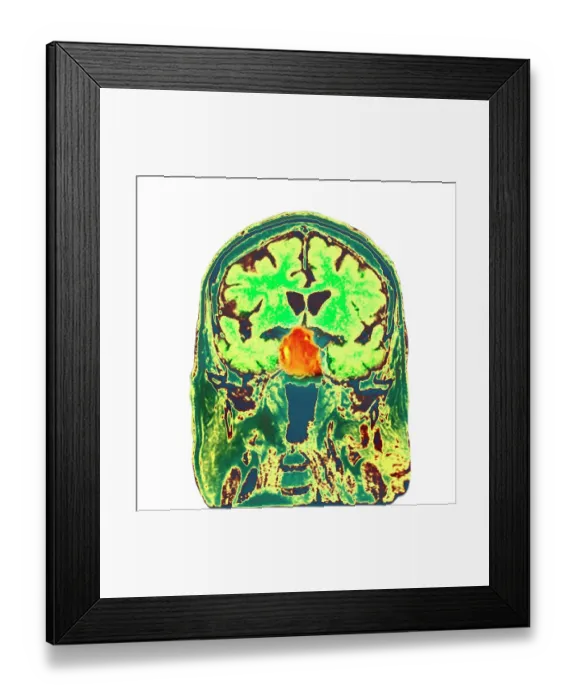 Framed Print : Pituitary tumour, CT scan Framed Print : Pituitary tumour, CT scan
