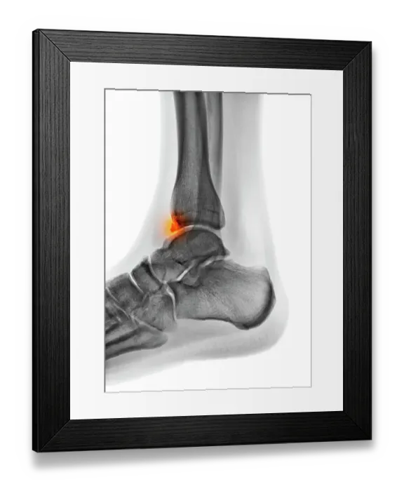 Framed Print : Tibial spur, X-ray Framed Print : Tibial spur, X-ray