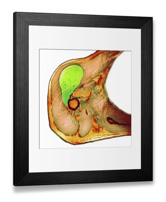 Framed Print : Lipoma of the shoulder, X-ray Framed Print : Lipoma of the shoulder, X-ray