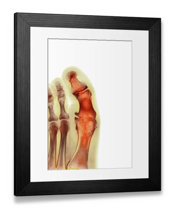 Framed Print : Degenerative foot deformation, X-ray Framed Print : Degenerative foot deformation, X-ray