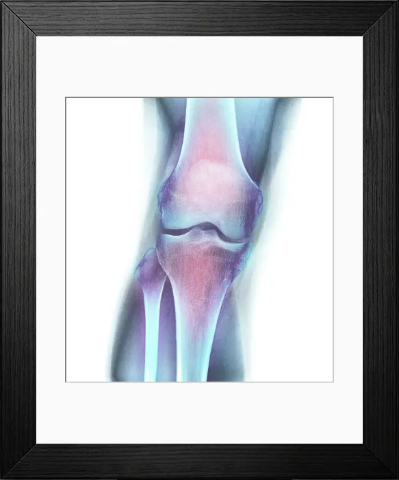Framed Print : Normal knee, X-ray Framed Print : Normal knee, X-ray